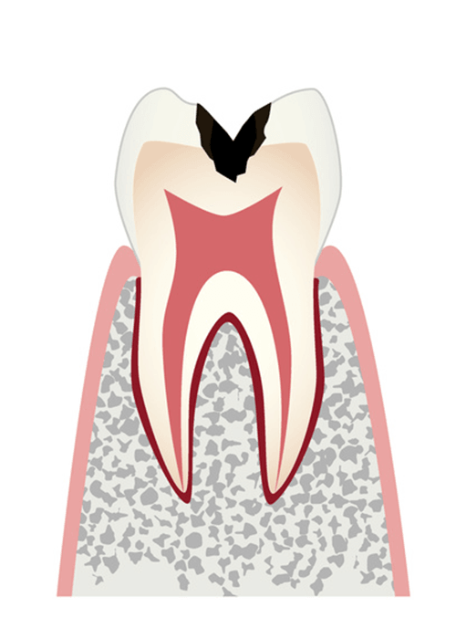 歯の内部の象牙質まで進行したむし歯