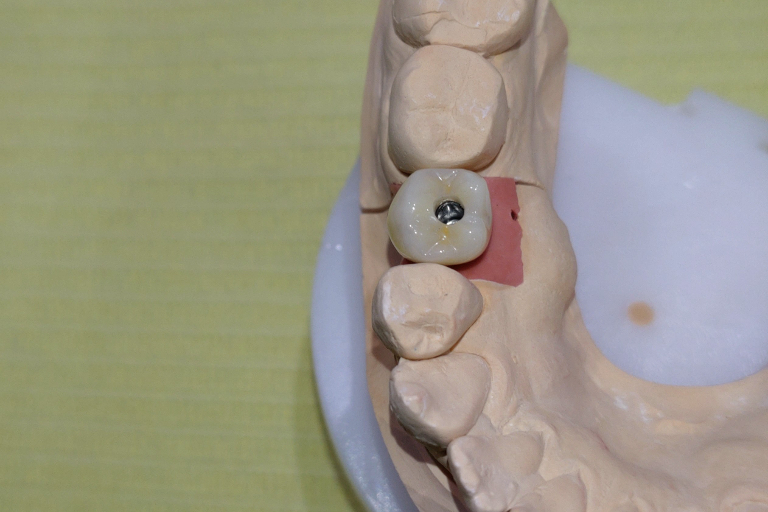 人工歯の作成と装着